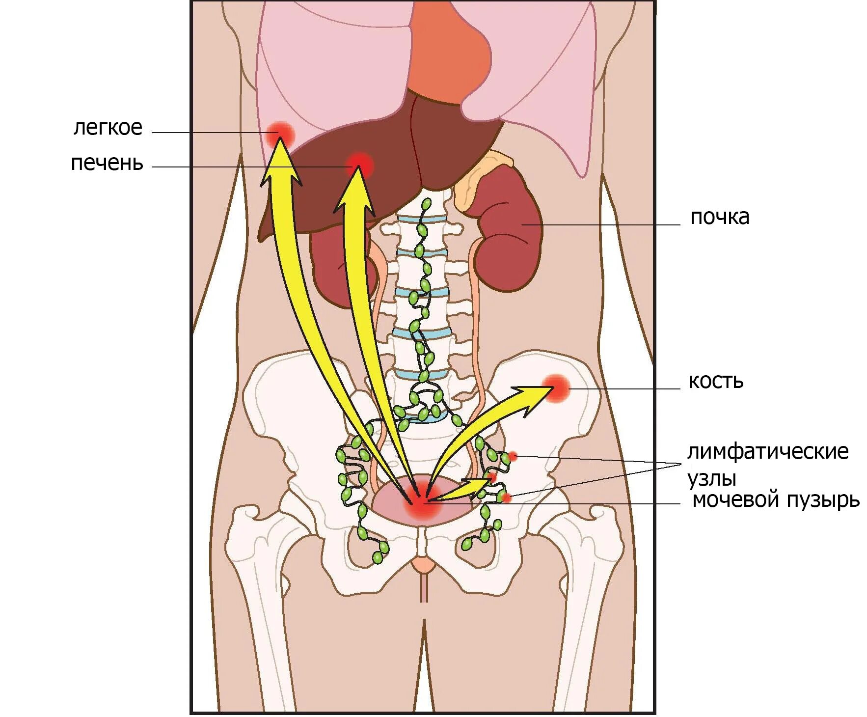 Мочевой пузырь печень. Регионарные лимфатические узлы мочевого пузыря. Метастазы в мочевом пузыре. Региональные лимфатические узлы мочевого пузыря. Метастазирование опухоли почки.