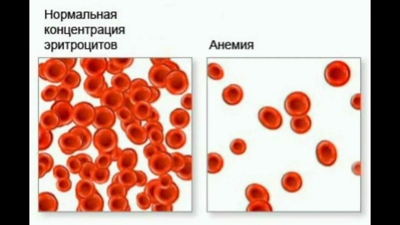 Дефицит железа в эритроците