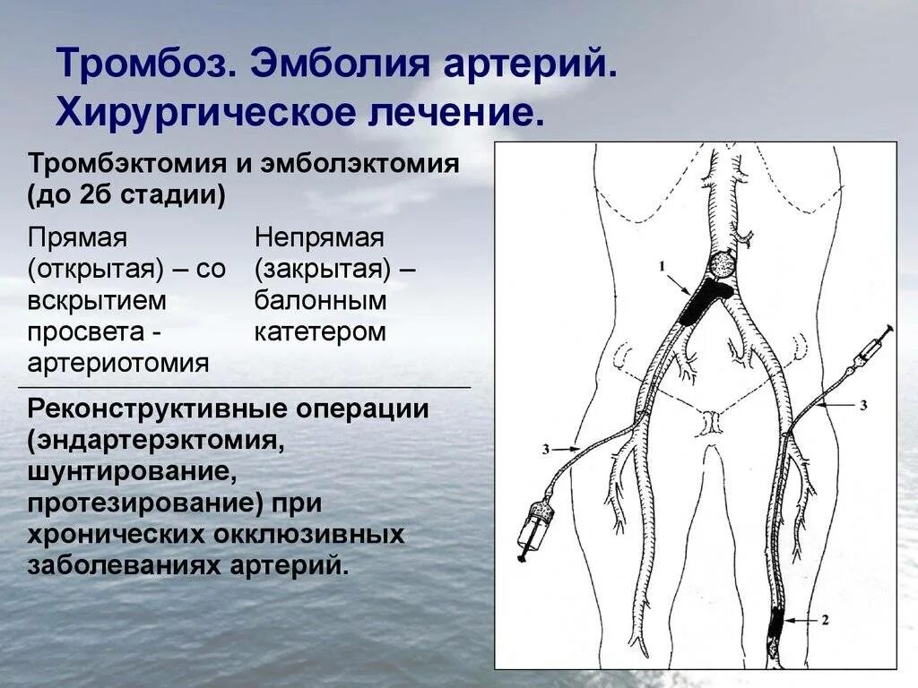 Тромбоз артерии лечение. Тромбоэмболия магистральных артерий нижних конечностей. Тромбоэмболия бедренной артерии. Острой тромбоэмболии сосудов конечностей. Тромбэктомия бедренной артерии.