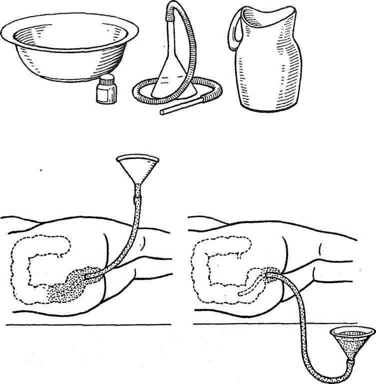 Постановка сифонной клизмы алгоритм. Постановка сифонной клизмы. Техника постановки сифонной клизмы алгоритм. Сифонная клизма алгоритм. Домашняя клизма очистить кишечник