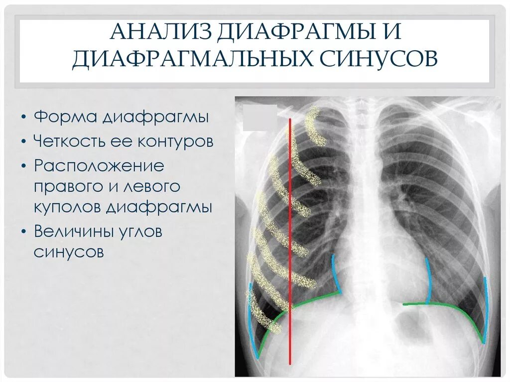 Синусы легких свободны. Реберно диафрагмальный угол на рентгене. Диафрагмальные синусы на рентгенограмме. Реберно-диафрагмальный синус рентген. Ребернодиафрагмальный синус на рентгенограмме.