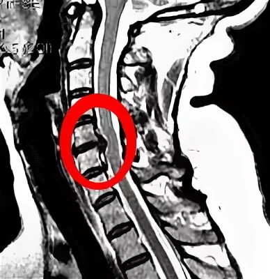 Грыжа шейного отдела позвоночника мрт.