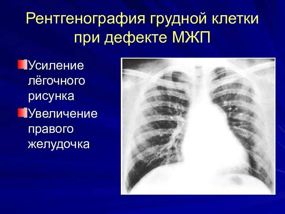 Умтление легосного рисунка. Усиление легочного рисунка. Усил ение логочного рисунка. Усиление легочного рисунка на рентгене.