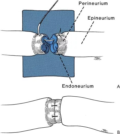 Сшивание нервов операция. Периневральный шов нерва. Сшивание нерва латынь