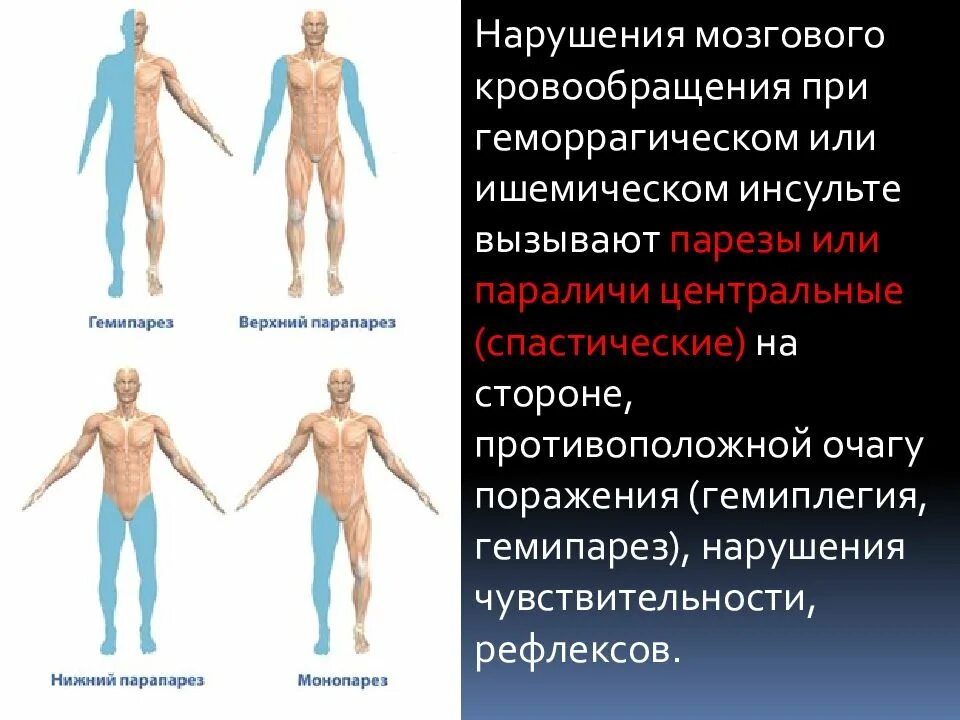 Почему руки парализовало. Левосторонний Центральный гемипарез. Гемипарез возникает при поражении. Инсульт симптомы гемипарез. Левосторонний гемипарез после инсульта.