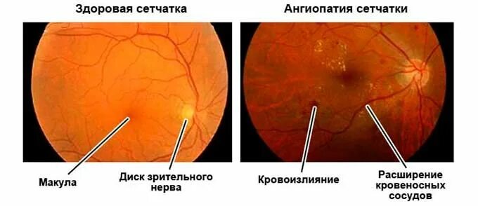 Ангиопатия и ретинопатия сетчатки. Гипертоническая ангиопатия сетчатки. Микроангиопатия сосудов сетчатки. Ангиопатия сетчатки глазное дно. Ангиопатия сосудов сетчатки что это