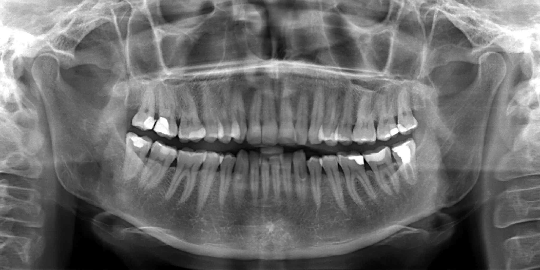 Снимок. Рентген ортопантомограмма зубов. Ортопантомограмма (обзорный снимок всей полости рта) 1100.