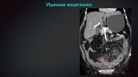 Тромбоэмболия брюшная