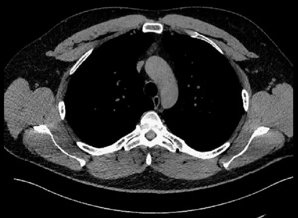 Асбестоз на рентгенограмме. Кт легких здорового человека. Диск для кт. Диск для кт. Хламидийная пневмония кт картина.