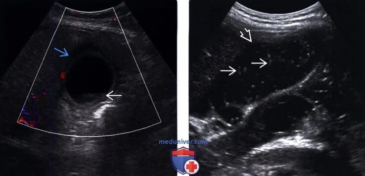 Эхогенный желчный пузырь. Хвост кометы на УЗИ печени. Эхогенная желчь в желчном пузыре. Эмпиема желчного пузыря на УЗИ.