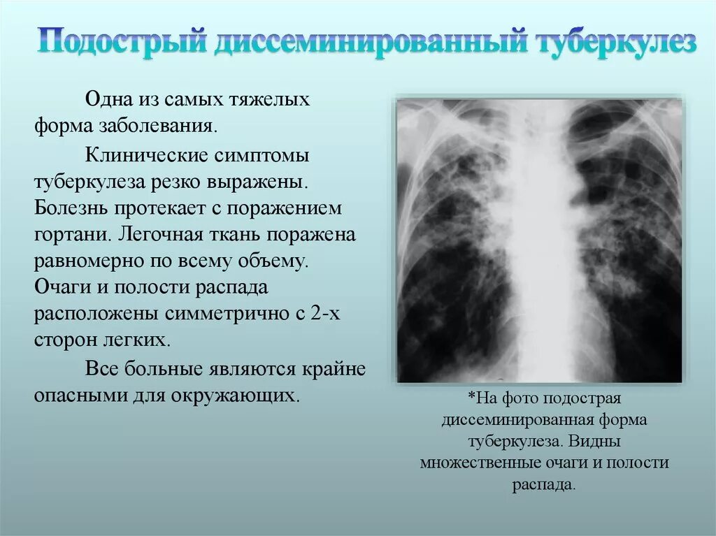 Внутренний туберкулез. Подострый диссеминированный туберкулез рентген. Хронический диссеминированный туберкулез рентген. Диссеминированный туберкулёз лёгких подострый рентген. Подострый диссеминированный туберкулез легких симптомы.