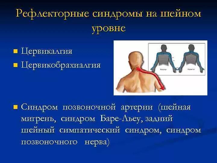 Дорсалгия шейного. Синдром цервикалгии шейный отдел. Шейный рефлекторный синдром. Цервикобрахиалгия цервикалгия. Рефлекторный синдром на шейном уровне это.