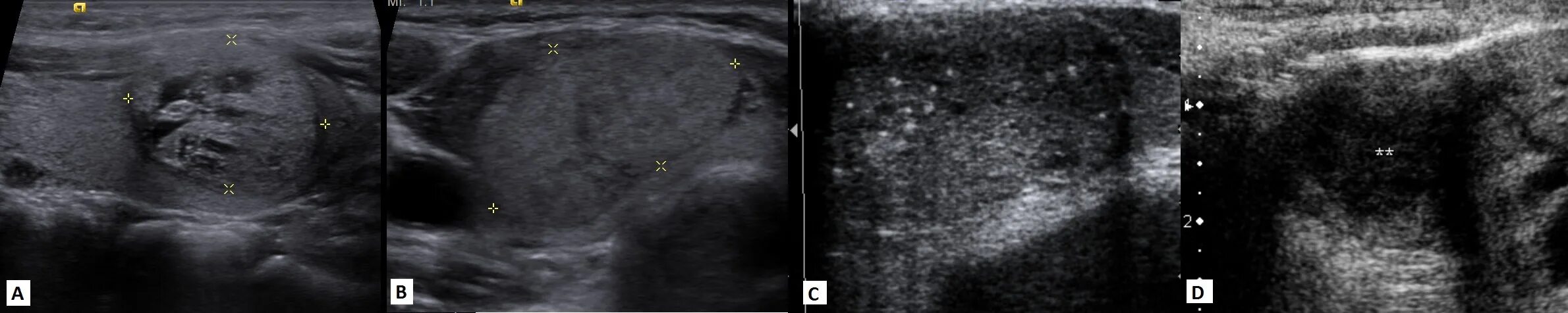Гиперэхогенное образование с акустической тенью. Гиперэхогенный узел в щитовидной железе УЗИ. Гиперэхогенный узел щитовидной железы на УЗИ. Гипоэхогенные узлы щитовидной железы. Гипоэхогенные узлы на УЗИ щитовидной железы.