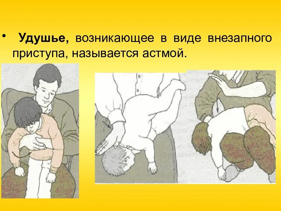 Удушье 5. Удушье, возникающее в виде внезапного приступа, называется. удушье, возникающее в виде внезапного приступа:. удушья внезапно развивающийся.