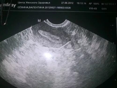 Беременность 2 нед. УЗИ 1-2 недели беременности. УЗИ 2-3 недели беременности фото. УЗИ 1-3 недели беременности. УЗИ 2 недели беременности.