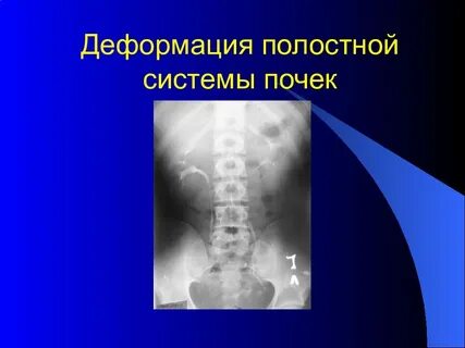 Деформация почек