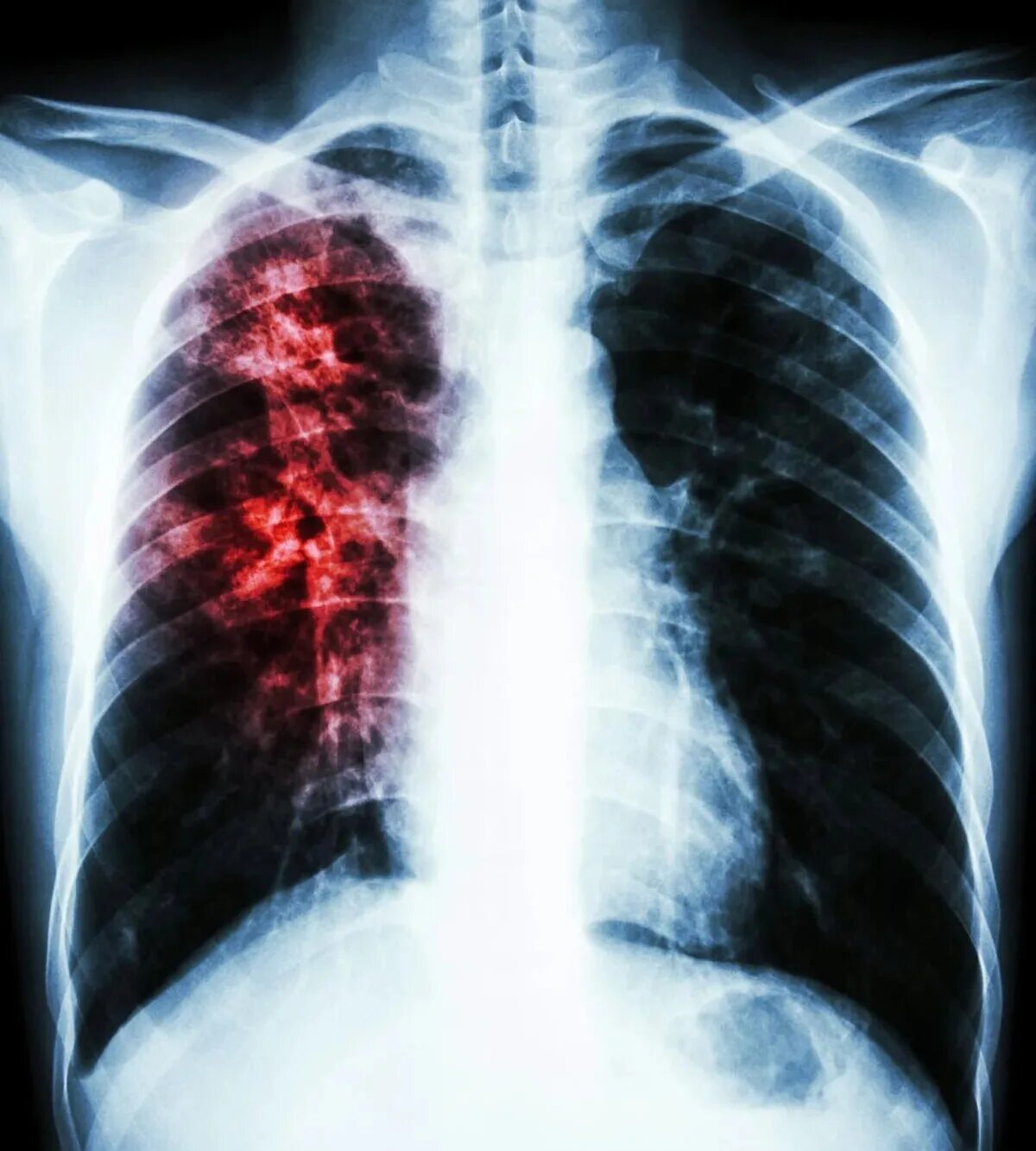Рентген грудной клетки туберкулез легких. Туберкулез легкого рентгенограмма. Туберкулез легких рентген. Легкие человека с туберкулезом