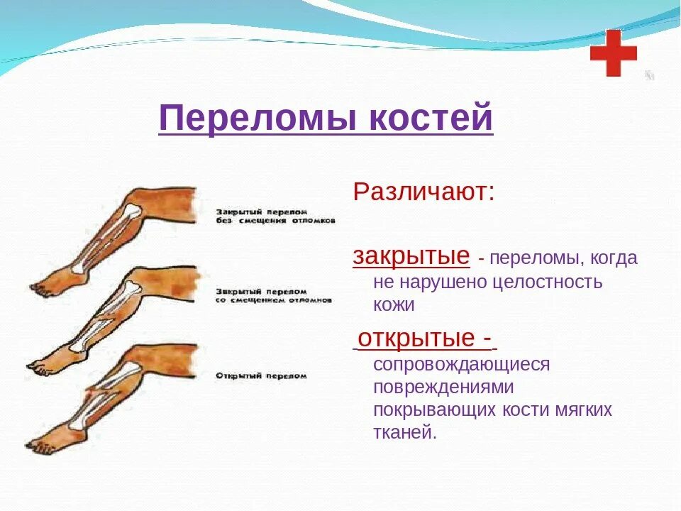 Кости первых текст. Открытый перелом и закрытый перелом таблица. Переломы  костей виды переломов признаки первая помощь. Открытый и закрытый перелом схема. Перелом костей конечностей признаки и первая помощь.