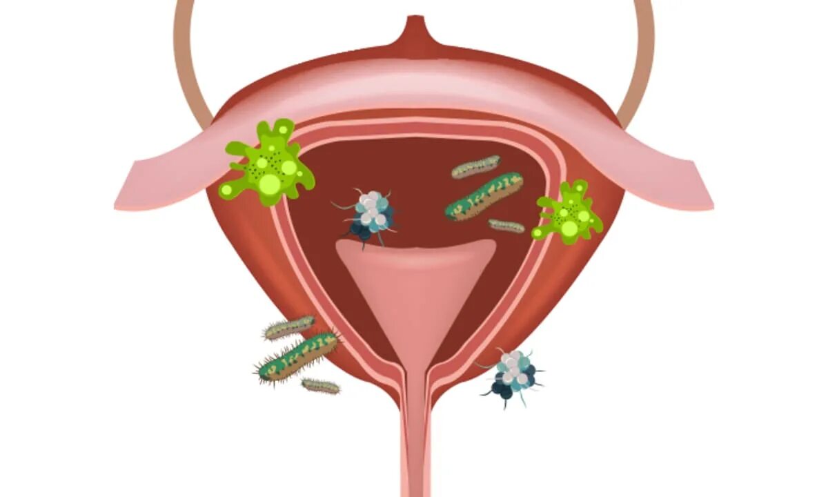 Мочевой пузырь рисунок цистит. Инфицирование мочевого пузыря. Неприятно в мочевом пузыре