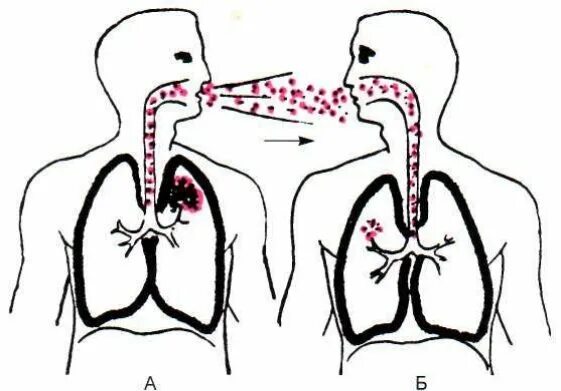 три звена эпидемического процесса схема. аспирационный механизм передачи. 3 фазы механизма передачи инфекции. механизм передачи возбудителя инфекции зависит. аспирационный механизм передачи возбудителя это.