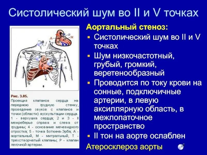 Систолический шум на легочной артерии. Систолический шум на аорте. Систолический шум в точке Боткина. Диастолические шумы сердца. Систолический шум это