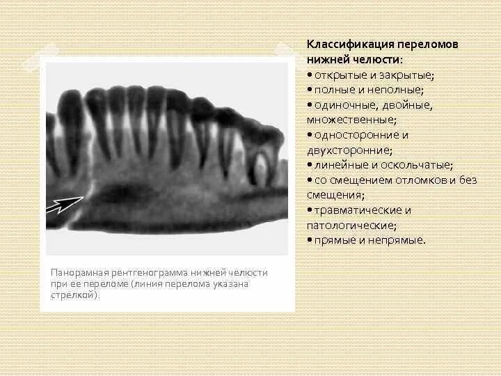 Перелом челюсти код мкб. Оскольчатые переломы нижней челюсти. линейные и оскольчатые переломы нижней челюсти. классификация переломов челюстей. классификация переломов нижней челюсти по.