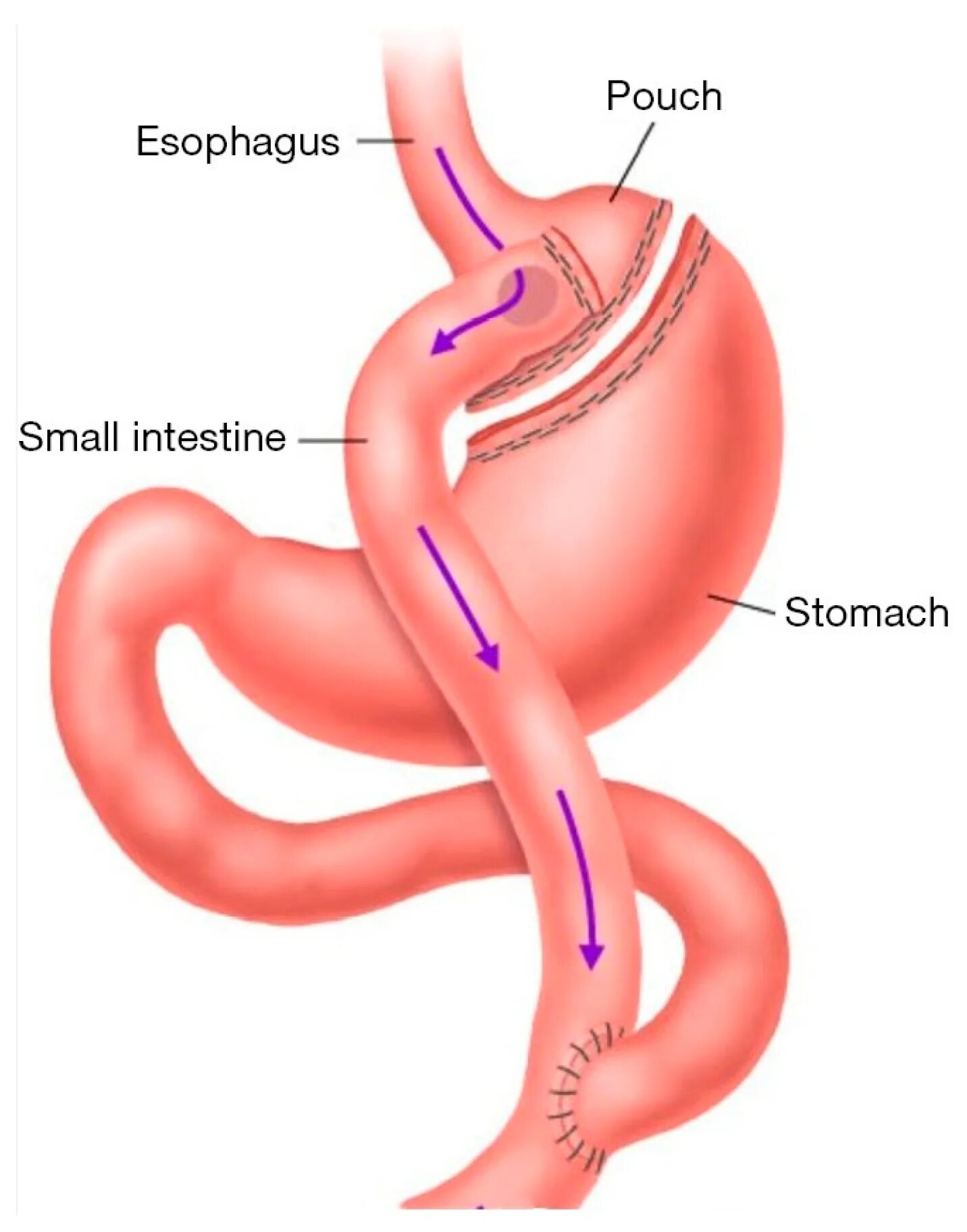 Желудочного шунтирования Roux-en-y.. Бариатрическая операция гастрошунтирование. Мини желудочное шунтирование. Гастрошунтирование желудка схема операции. Анастомоз пищевода