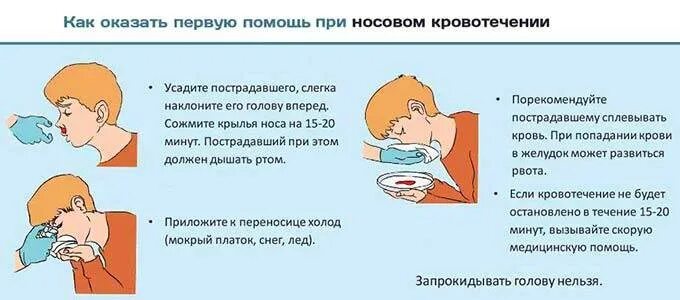 Кровотечение из носа из одной ноздри причины. Носовое кровотечение первая помощь. первая помощь при носовом кровотечении. остановить кровотечение из носа первая помощь. кровотечение из носа при давлении.