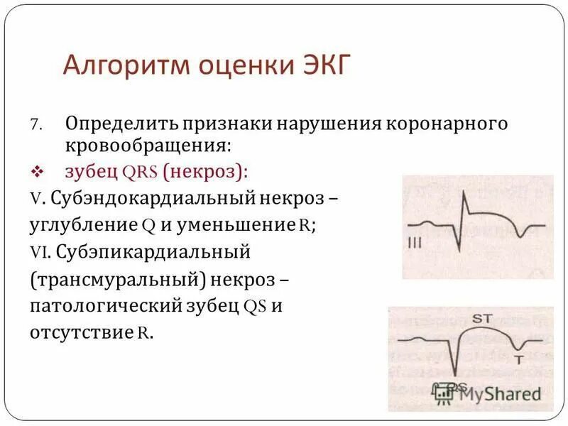 Основным экг признаком некроза сердечной мышцы является. Некроз сердечной мышцы на экг. Инфаркт миокарда обусловлен. Инфаркт миокарда некроз. Некроз миокарда на экг.