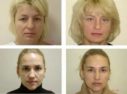 Подтяжка лица реабилитация