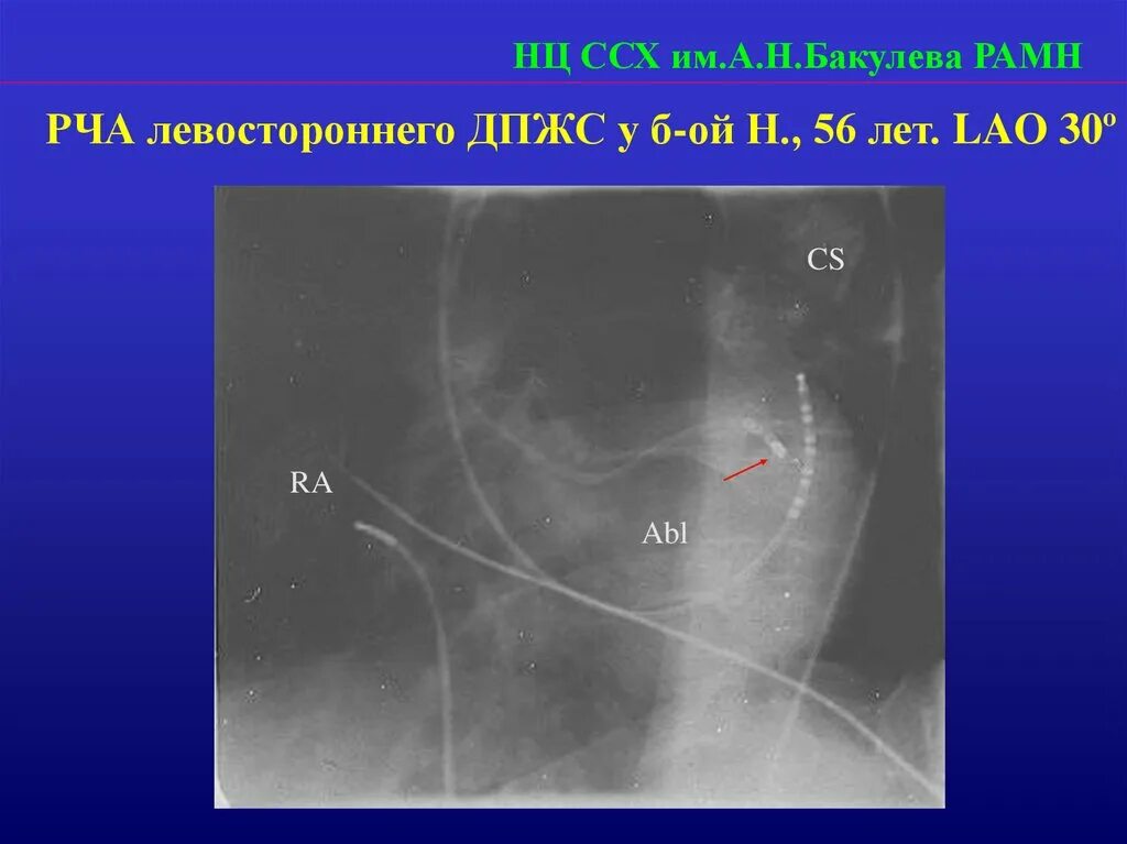 Операция на сердце абляция. Рча сердца в бакулева. Центр кардио сосудистой хирургии им бакулева. Кардиология в операционной. Интервенционный кардиолог.