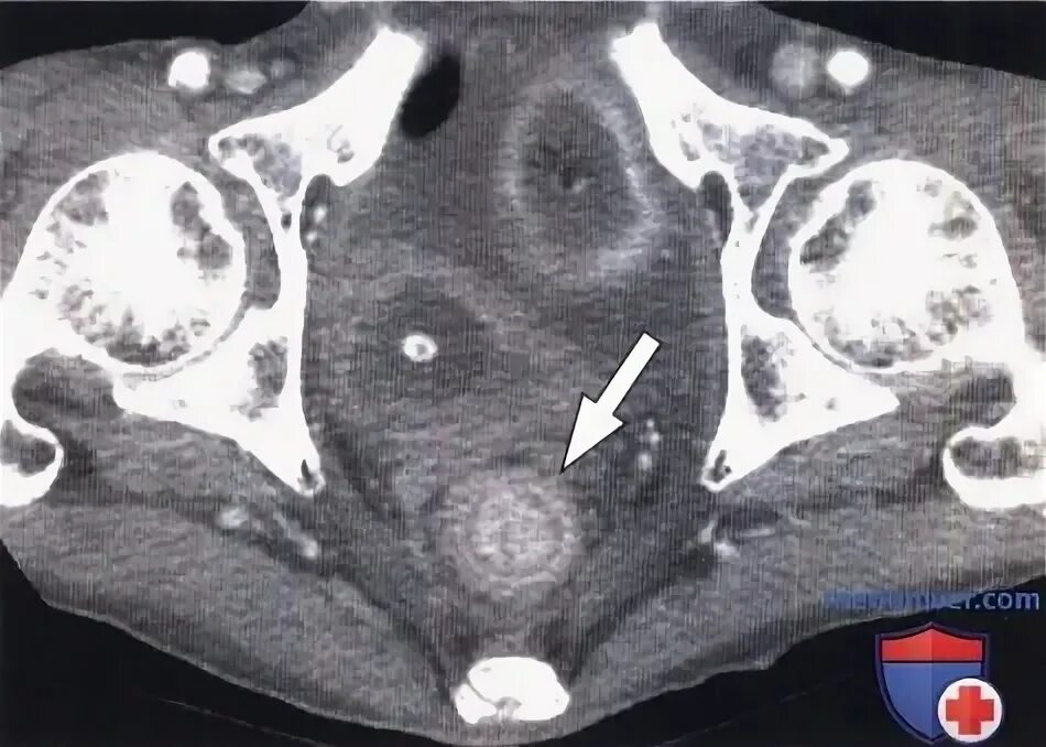 Опухоль стенки прямой кишки на кт.