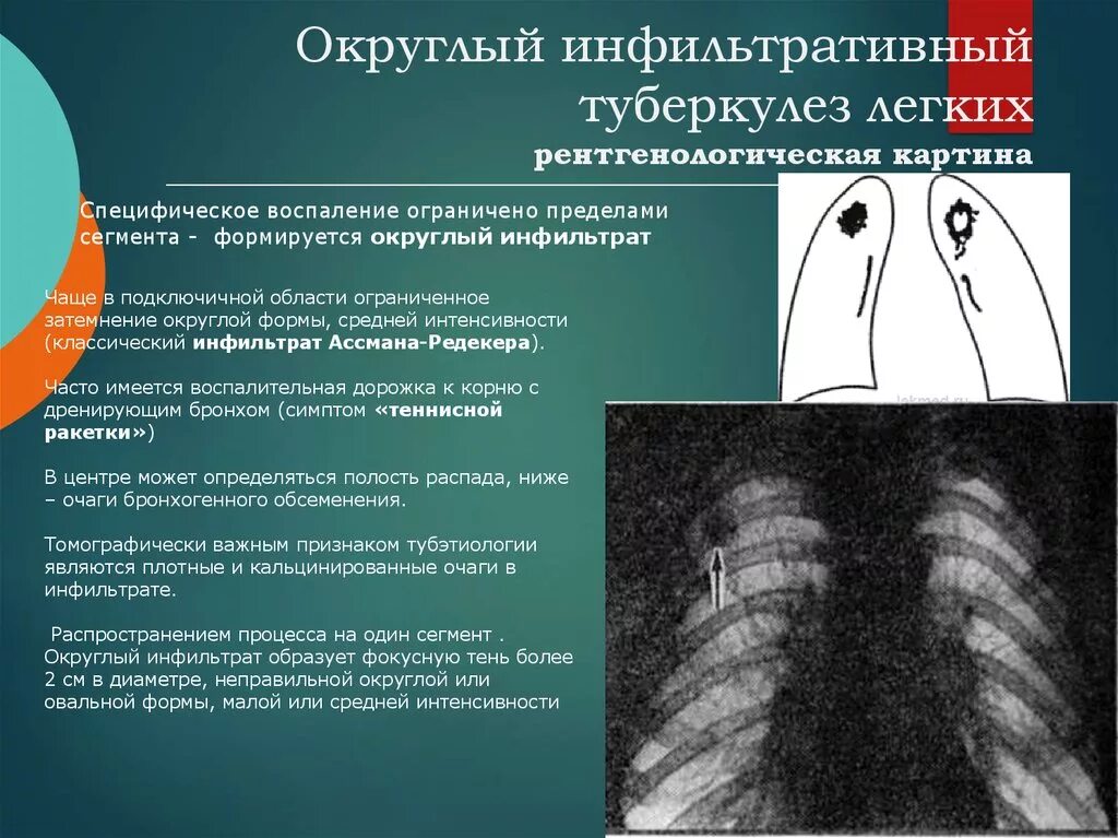 Фазы очагового туберкулеза