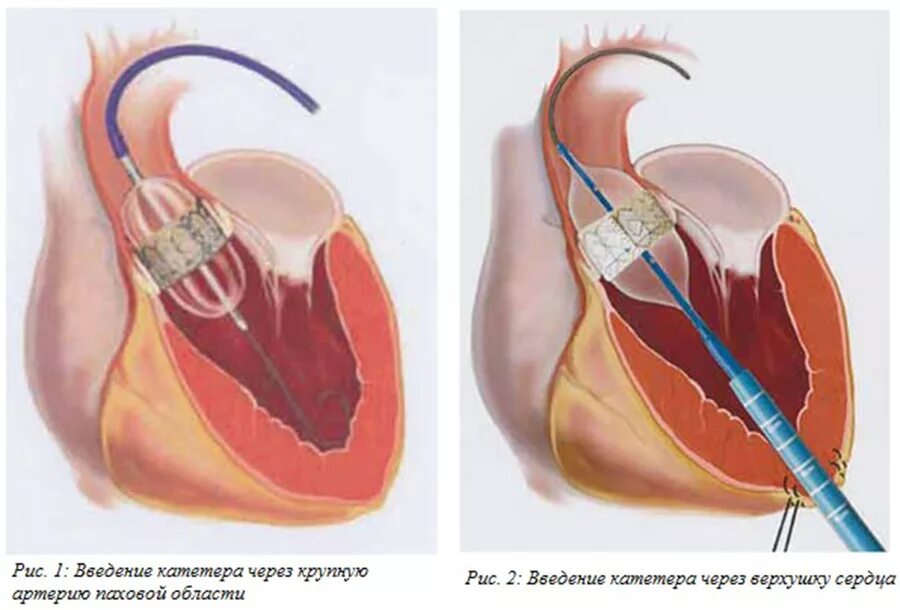 Транскатетерная имплантация митрального клапана. Катетеризация полостей сердца при митральной недостаточности. Вальвулопластика митральный стеноз. Катетеризация полостей сердца методика. Как клапан делает операция