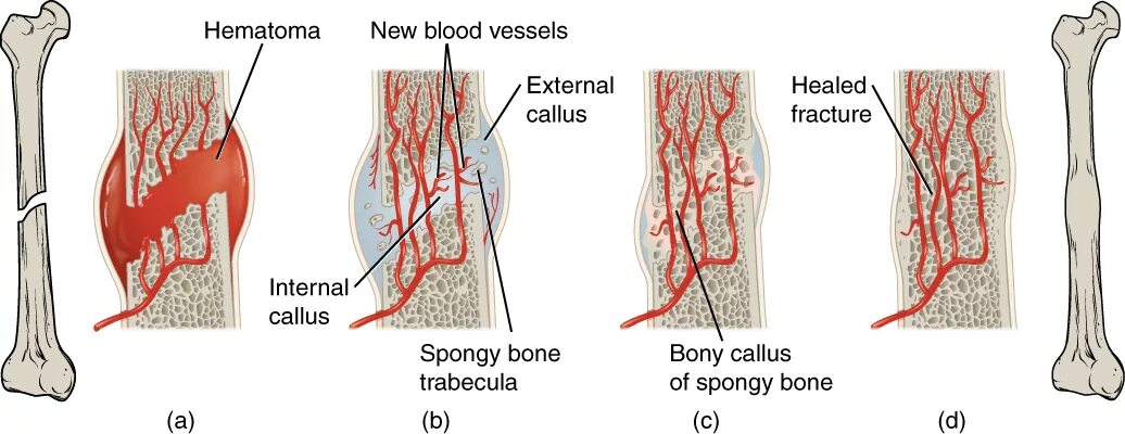 Через 1 стадии. Стадии формирования костной мозоли. Фазы формирования костной мозоли. Этапы заживления перелома кости. Заживление перелома 4 стадии.