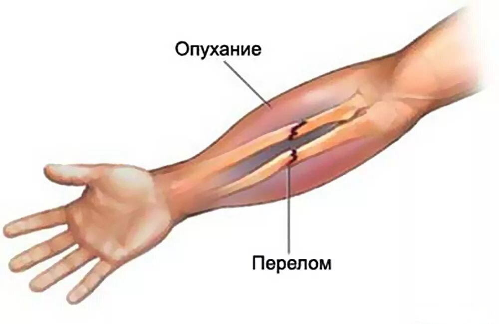 Лечение предплечья. Перелом лучевой кости руки симптомы. Стилоидит локтевой кости. Признаки трещины лучевая кость. Симптомы трещины в кости предплечья.