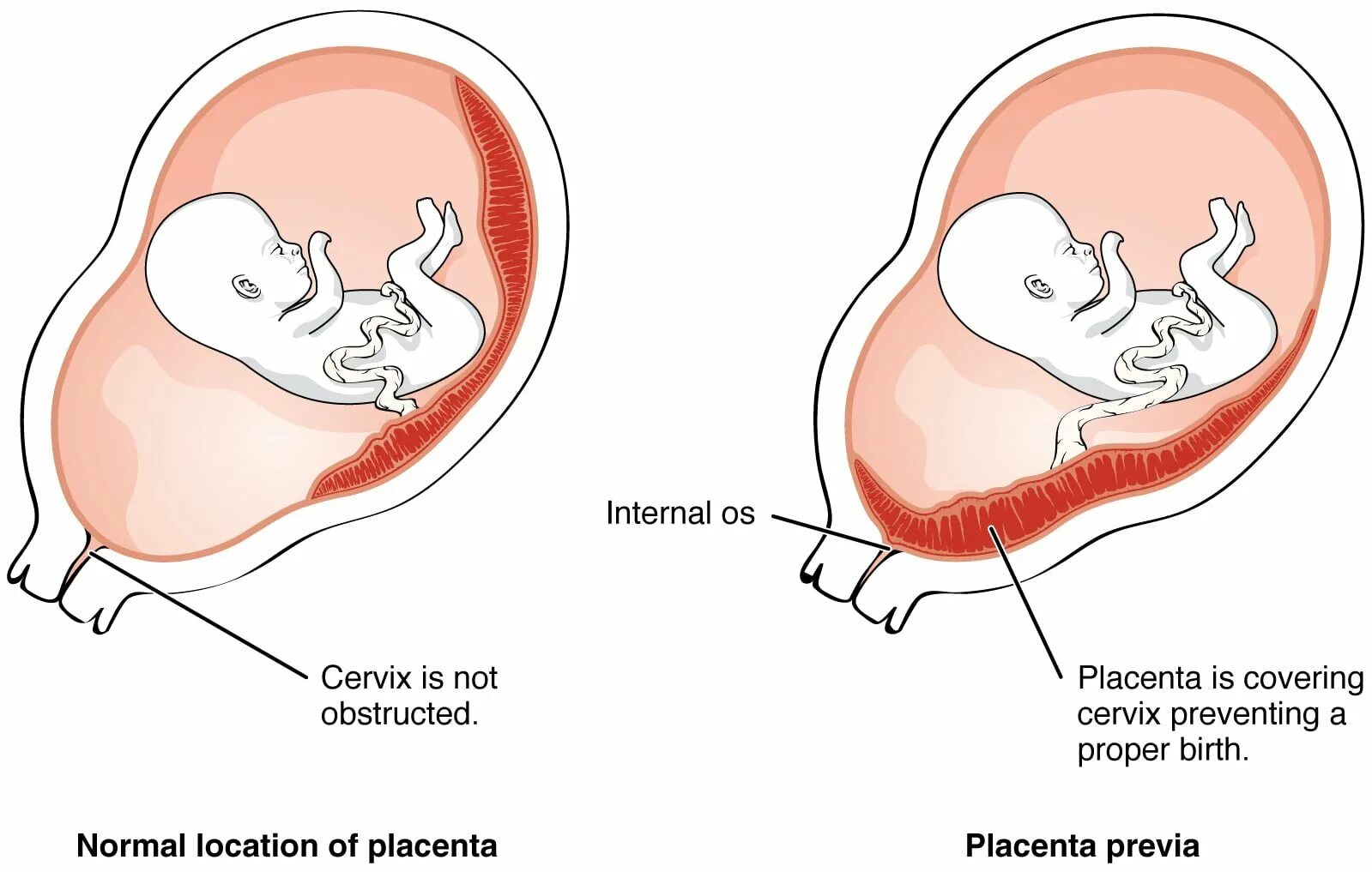 Низкое расположение плаценты при беременности 20. Краевое предлежание плаценты УЗИ. Низкое расположение хориона при беременности. Низкое расположение плаценты при беременности 12 недель. 13 неделе беременности плацента