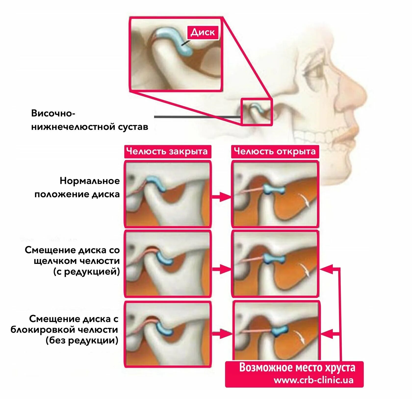 Щелкает челюсть при открытии рта что делать. Переднее смещение суставного диска ВНЧС. Височно челюстной сустав.