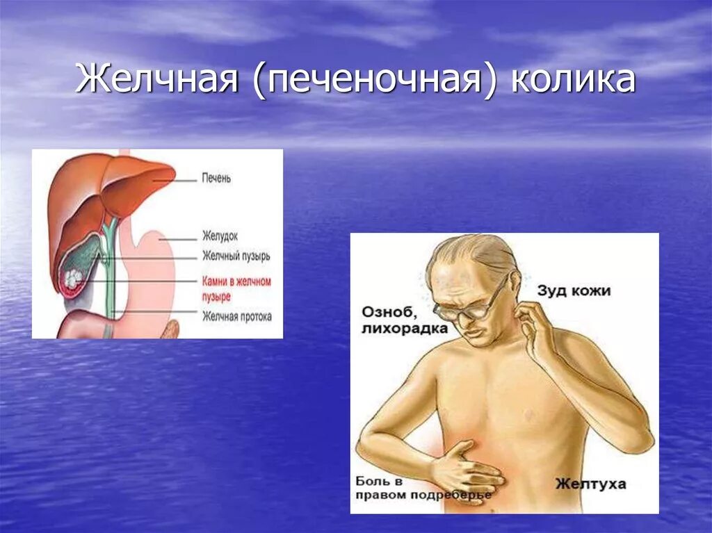 Желчный спазм симптомы. Печеночная колика. Желчная колика. Желчная и печеночная колика.