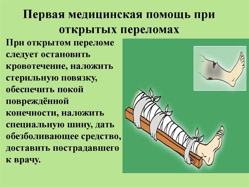 В случае открытого перелома. Первая врачебная помощь при открытых переломах. При открытых переломах конечностей следует. Первая при открытом переломе.