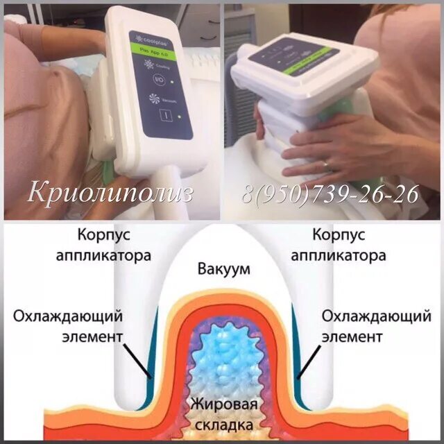 Криолиполиз в самаре. Криолиполиз. Криолиполиз косметология. Криолиполиз манипула. Аппаратная косметология криолиполиз.