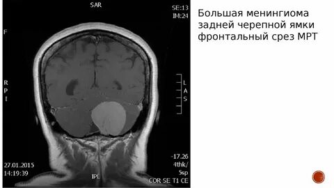 После операции менингиомы