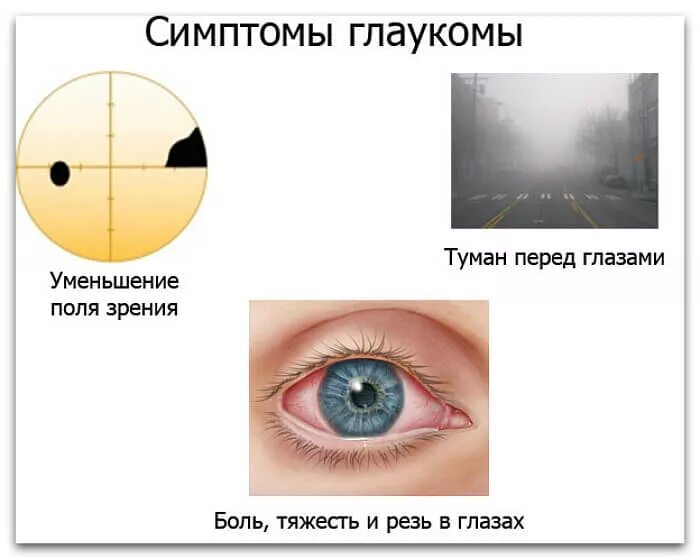 Зрение 1 симптомы. Ретинопатия катаракта глаукома. Глаукома характеризуется следующими клиническими признаками. Основные симптомы глаукомы.
