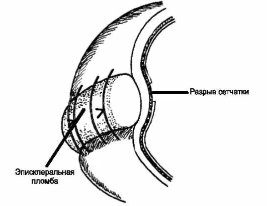Пломбирование сетчатки. Отслойка сетчатки экстрасклеральное пломбирование. Склеральное пломбирование сетчатки. Пломбирование при отслойке сетчатки. Пломба при отслойке сетчатки.