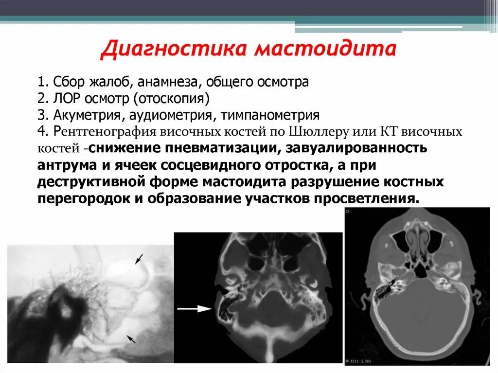 Утолщение слизистой сосцевидного отростка. Мастоидит на кт. Хронический мастоидит на кт. Мастоидит височной кости кт. Мастоидит на кт височных костей.