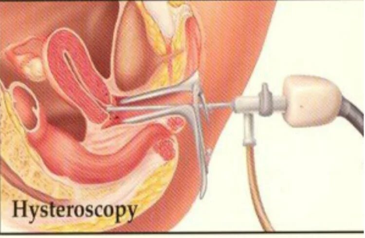 Эндометриоз матки гистероскопия. Полип эндометрия гистероскопия. РДВ шейки матки гистероскопия. Вакуумное выскабливание полости матки. После выскабливание цервикального канала