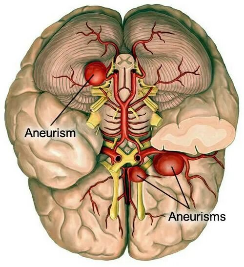 Аневризма сосудов головного мозга локализация. МИЛЛИАРНАЯ аневризма головного мозга. Локализация аневризм сосудов головного мозга. Типа аневризма головного мозга.