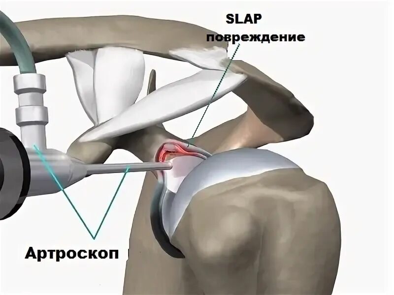 Плечевая губа суставная разрыв. Slap синдром плечевого сустава операция. Slap повреждение плечевого сустава операция. Повреждения суставной губы плечевого сустава slap. Слэп синдром плечевого сустава.