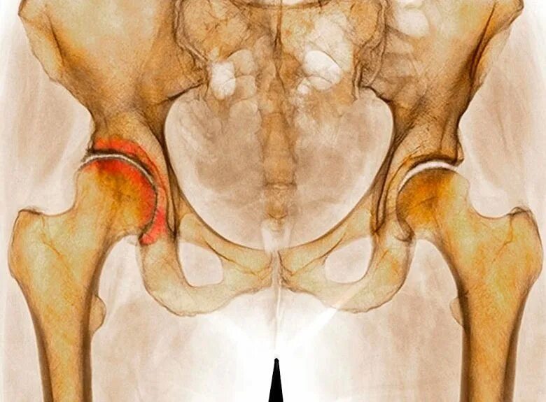 К какому врачу обращаться с тазобедренным суставом. Диспластический артроз тазобедренного сустава. Диспластический коксартроз. Коксартроз (артроз тазобедренного сустава). Диспластический коксартроз 3 степени.