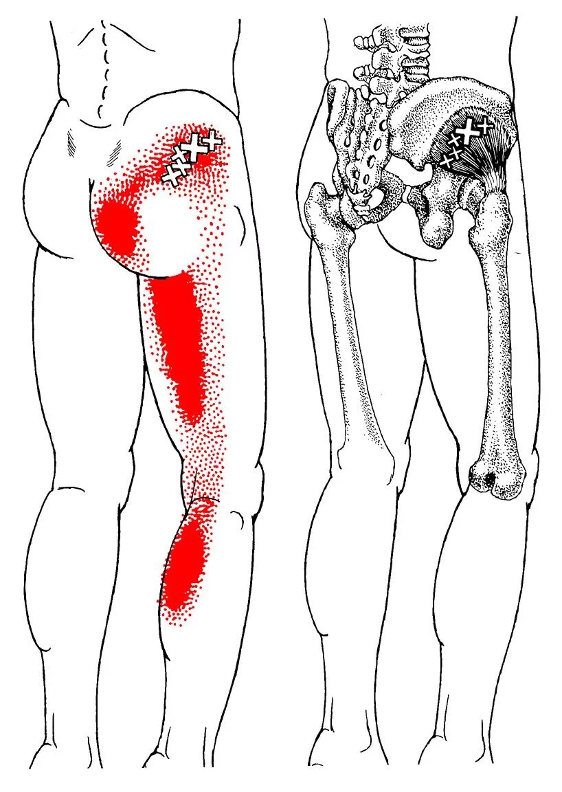 Боли внизу поясницы отдает в ногу. Триггерные точки ягодичной мышцы. Мышцы задней поверхности бедра триггерные точки. Квадратная поясничная мышца триггерные точки. Триггерные точки на ягодицах.